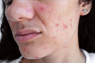 Sivilceli ve sivilceli genç bir kızın yüzü yakın plan çekimdir. Sorunlu ergen cildi