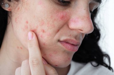 Sivilceli ve sivilceli genç bir kızın kadın yüzü yakın plan çekimdir. Sorunlu ergen cildi