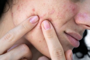 Genç kadın sivilce ve kadın yüzünde parmaklarıyla sivilce yapıyor. Derisi sorunlu genç kız. Yakın plan.