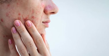 Sivilceli kadın yüzü ve sorunlu deride sivilceler izole edilmiş beyaz arka planda yakın plan.