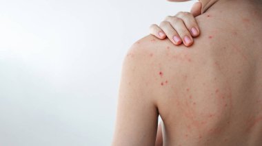 Sivilceleri ve sivilceleri olan, beyaz, izole bir arka planda yaşayan genç bir kadının sırtı ve omuzları. Derisi sorunlu bir kızın vücudu.