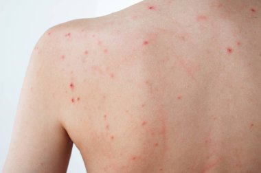 Sivilceli ve sivilceli bir kadının sırtı ve omuzları. Derisi sorunlu bir kızın vücudu.