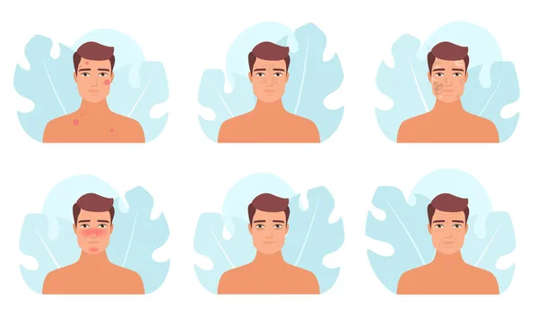 Männliche Hautprobleme Setzen Vektor Illustration Cartoon Mann Mit Verschiedenen Arten — Stockvektor