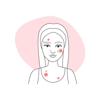 Sivilce tedavisinden önce yüzünde sivilce olan üzgün genç bir kadın.