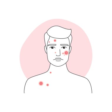 Tedavi öncesi akne ve deri iltihabı olan üzgün bir adam.