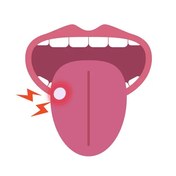 stock vector Mouth with canker sore. Editable vector.