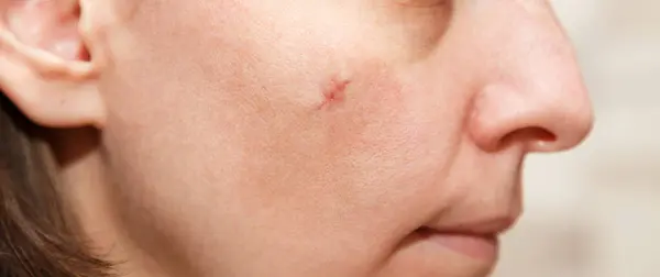 Real Scar Young Woman Face Scar Cheek Mole Removal Surgery Stock Photo