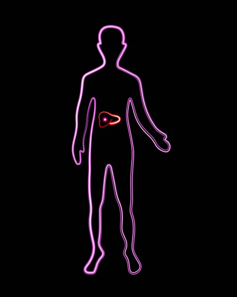 有肝脏器官的人体轮廓的矢量分离图解 肝脏疼痛的集中程度 — 图库矢量图片