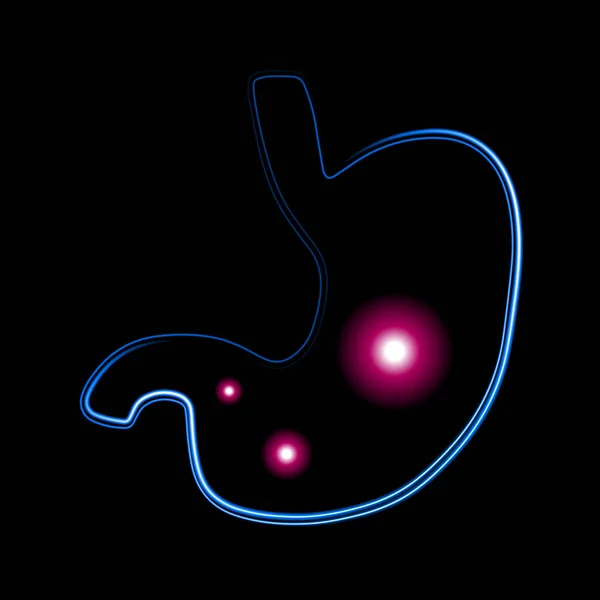 Ilustración Aislada Vectorial Del Estómago Humano Gas Estómago Enfermedades Estomacales — Archivo Imágenes Vectoriales