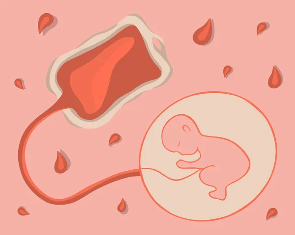 Διανυσματική Απεικόνιση Αίματος Ομφάλιου Λώρου Βλαστικά Κύτταρα Παγωμένα Βλαστοκύτταρα Συλλογή — Διανυσματικό Αρχείο