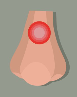 Sinüzitin izole edilmiş vektör çizimi. Burnun akıyor. Burun tıkanıklığı.