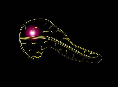 Neon etkisine sahip pankreasın izole edilmiş bir temsili. Pankreas ağrısı. Pankreas kanseri.