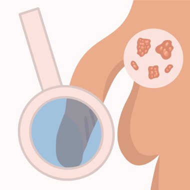 Erkeklerde genital uçukların temsili vektör çizimi. Cinsel uçuk döküntüsü..