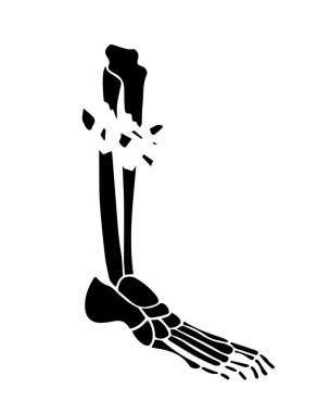 Kaval kemiğindeki açık kırığın vektör çizimi. Bacağın röntgeni..