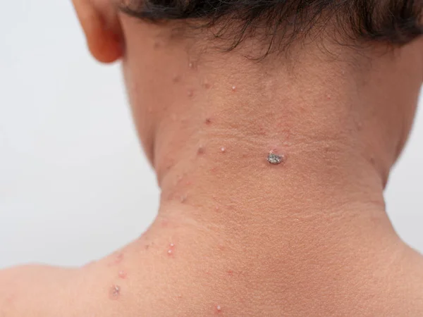 close up of child with smallpox on back of neck