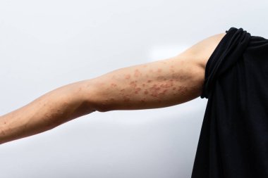 Erkek elinin dermatiti, alerjik deri iltihabı egzaması. Dermatit belirtileri, deri detay dokusu, deri mantarı. Dermatoloji kavramı.