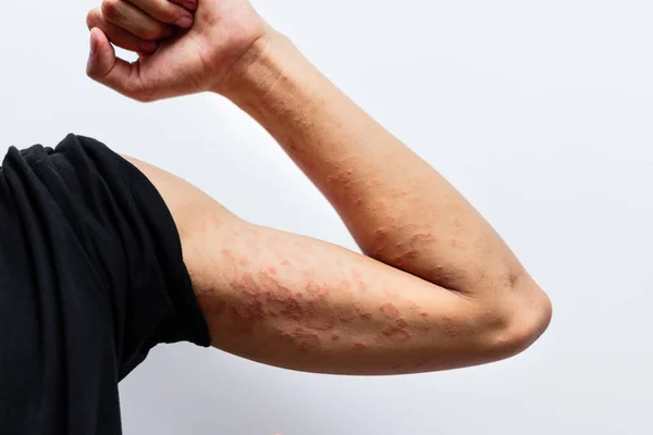 Close Dermatitis Man Hand Allergic Rash Dermatitis Eczema Skin Patient — Stock Photo, Image