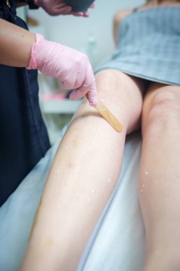 Beyaz lekeli bir hastanın bacağına yakın çekim, pembe eldivenli ve koyu renk elbiseli bir teknisyenden lazer tedavisi görüyor, profesyonel bir güzellik salonu ortamında..