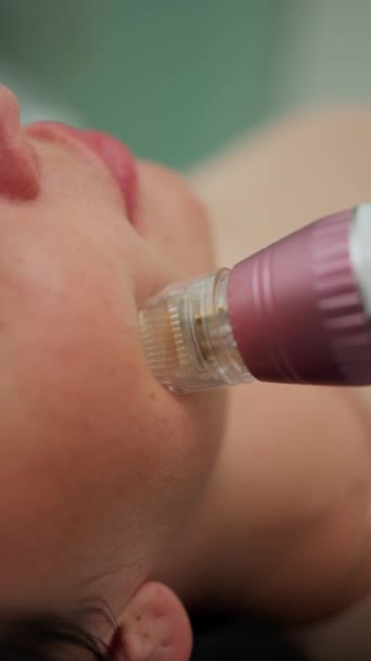 Een Cosmetoloog Voert Een Laser Verjonging Procedure Het Verwijderen Van — Stockvideo