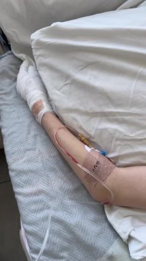 Yaralı eli bandajlı ve serumlu bir hasta hastane yatağında yatıyor. Steril klinik ortamda geçirdiği travma sonrası koluna sarılmış çocukların tedavi gördüğü yakın çekim..