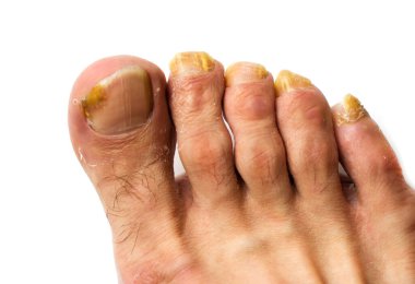 Beyaz arka planda bir adamın ayağının tırnaklarındaki mantarı kapat.