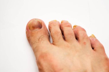 Beyaz arka planda bir adamın tırnaklarındaki mantarı kapat.