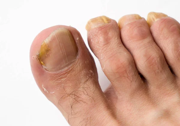 Close up fungus on the nails of a mans foot on a white background