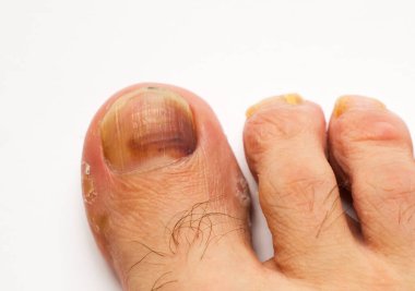 Beyaz arka planda bir adamın tırnaklarındaki mantarı kapat.