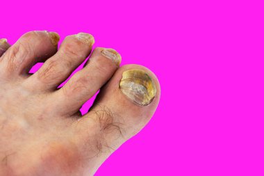 Close-up of all male foot thumbnail, fungal nail in pink background clipart