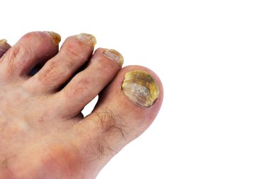 Tüm erkek ayak baş parmağının yakın çekimi, beyaz arka planda mantar tırnağı