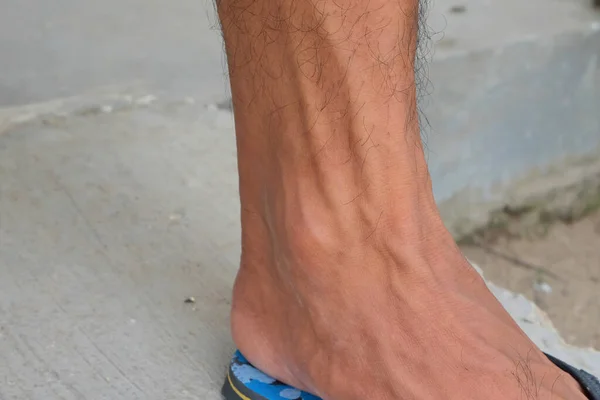 Вены Мужских Ногах Крупный План Мужской Ноги — стоковое фото