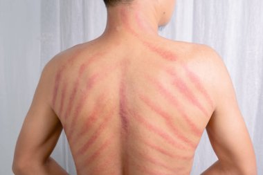 Adamın sırtındaki kırmızı leke Gua Sha tarafından yapılmış. Gua sha kan dolaşımını iyileştirmek ya da soğuk algınlığını tedavi etmek için doğal bir alternatif terapidir.