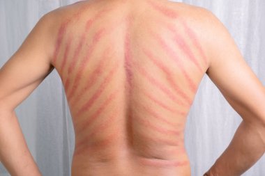 Adamın sırtındaki kırmızı leke Gua Sha tarafından yapılmış. Gua sha kan dolaşımını iyileştirmek ya da soğuk algınlığını tedavi etmek için doğal bir alternatif terapidir.