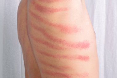 Adamın sırtındaki kırmızı leke Gua Sha tarafından yapılmış. Gua sha kan dolaşımını iyileştirmek ya da soğuk algınlığını tedavi etmek için doğal bir alternatif terapidir.