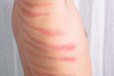 Adamın sırtındaki kırmızı leke Gua Sha tarafından yapılmış. Gua sha kan dolaşımını iyileştirmek ya da soğuk algınlığını tedavi etmek için doğal bir alternatif terapidir.