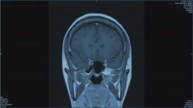 Beynin manyetik rezonans görüntüleri, beyin MR 'ı, çoklu vasküler enfarktüsleri olan bir hastanın, ön görüş, karşıt tek renkli animasyon Tertemiz Döngü. Yüksek kalite 4K görüntü. Yüksek