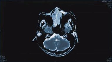 Beynin manyetik rezonans görüntüleri, beyin MR 'ı, birden fazla damar enfarktüsü olan bir hastanın üst görüntüsü, üst görünüm kontrast, tek renkli animasyon, kusursuz döngü. Yüksek kalite 4k görüntü