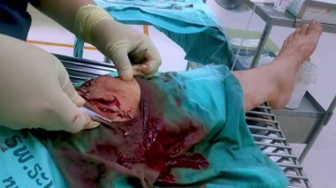 Tıbbi bir ortamda cerrahi prosedür: sunulan bakıma ve kullanılan cerrahi tekniklere vurgu yaparak, ciddi bir diz yarasını önemli bir kan kaybıyla açıp tedavi etmeye odaklanmaktır. Yüksek kalite 4k
