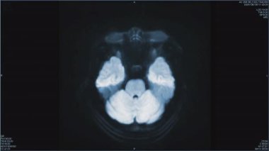 Beynin manyetik rezonans görüntüleri, beyin MR 'ı, birden fazla damar enfarktüsü olan bir hastanın, üst görünümü, tek renkli animasyonsuz döngüsü. - Evet. Yüksek kalite 4k görüntü