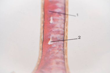 Purulent Sputum in Trachea and on Bifurcation in an anatomical illustration. clipart