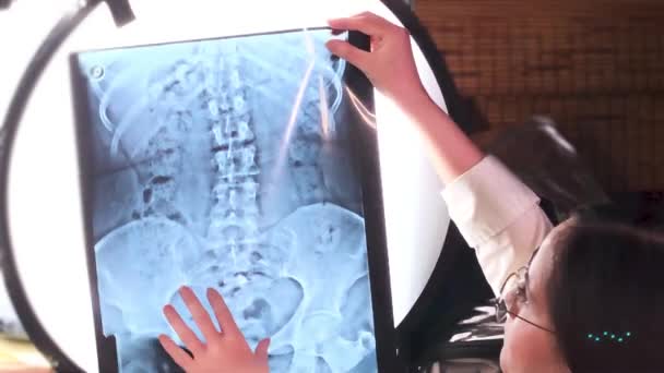 Radiologin Orthopädin Kontrolle Der Wirbelsäule Bei Frontaler Röntgenbeobachtung Angeborener Skoliose — Stockvideo