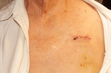 Kalp pili takmak için yaşlı bir insanın göğsünde ameliyat sonrası yara izi var.