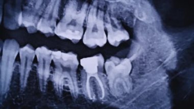 X-ray image of the jaw of all human teeth close-up. Magnetic resonance imaging of teeth. The doctor examines the x-ray of the tooth. Health care and medicine, dentistry, dentistry concept.