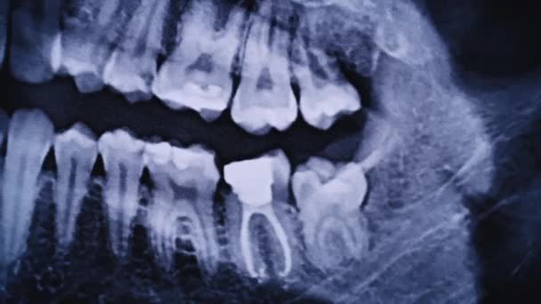 Ray Image Jaw All Human Teeth Close Magnetic Resonance Imaging — Stock video
