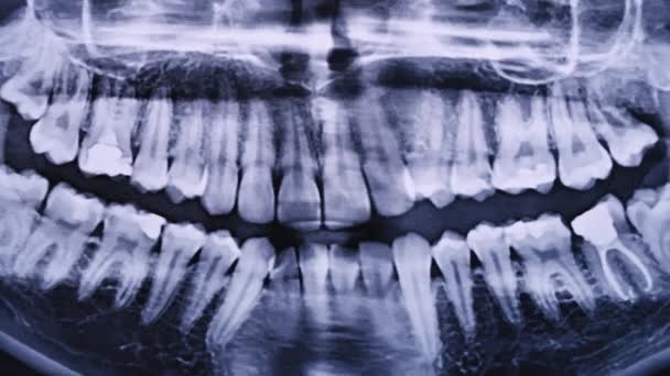 Imaginea Raze Maxilarului Tuturor Dinților Umani Aproape Imagistica Prin Rezonanță — Videoclip de stoc