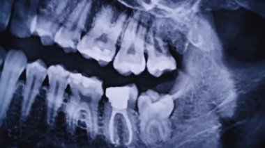 X-ray image of the jaw of all human teeth close-up. Magnetic resonance imaging of teeth. The doctor examines the x-ray of the tooth. Health care and medicine, dentistry, dentistry concept.