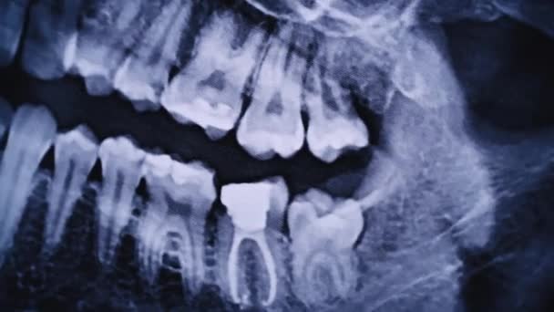 Εικόνα Ακτίνων Της Γνάθου Όλων Των Ανθρώπινων Δοντιών Από Κοντά — Αρχείο Βίντεο