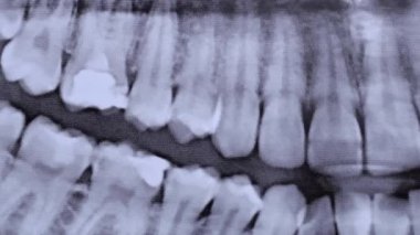 X-ray image of the jaw of all human teeth close-up. Magnetic resonance imaging of teeth. The doctor examines the x-ray of the tooth. Health care and medicine, dentistry, dentistry concept.