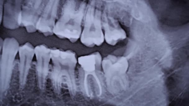Ray Image Jaw All Human Teeth Close Magnetic Resonance Imaging — Vídeo de stock