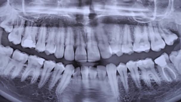 すべての人間の歯の顎のX線画像を閉じる 歯の磁気共鳴画像 医者は歯のX線を検査する ヘルスケアと医療 歯科の概念 — ストック動画